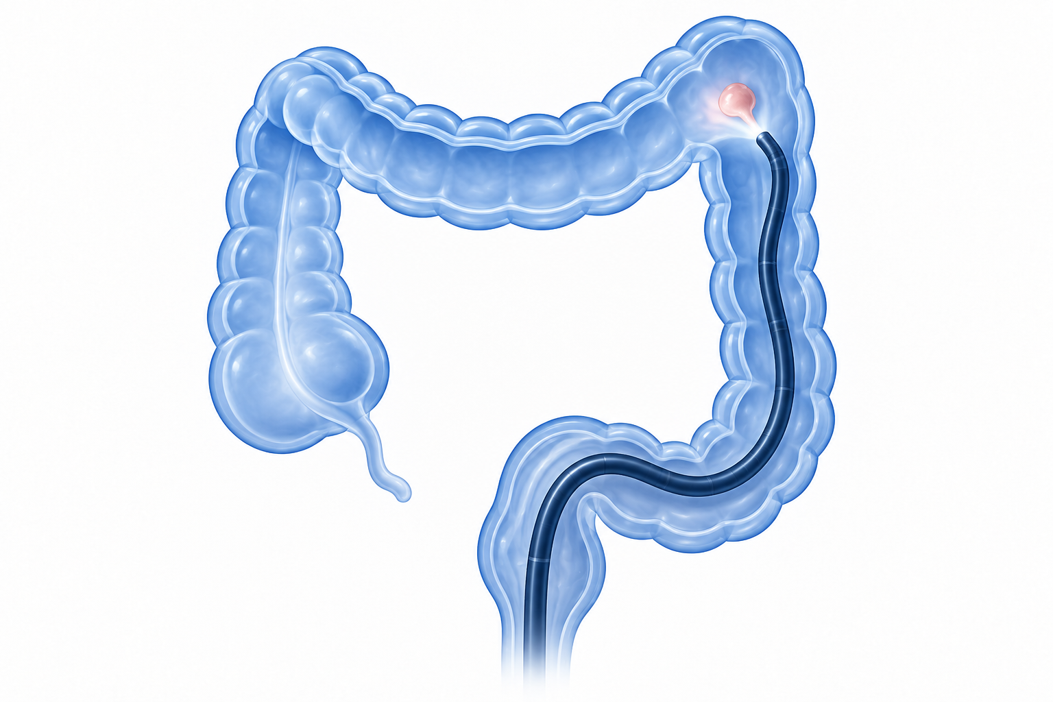Ilustración conceptual de un colonoscopio dentro del colon