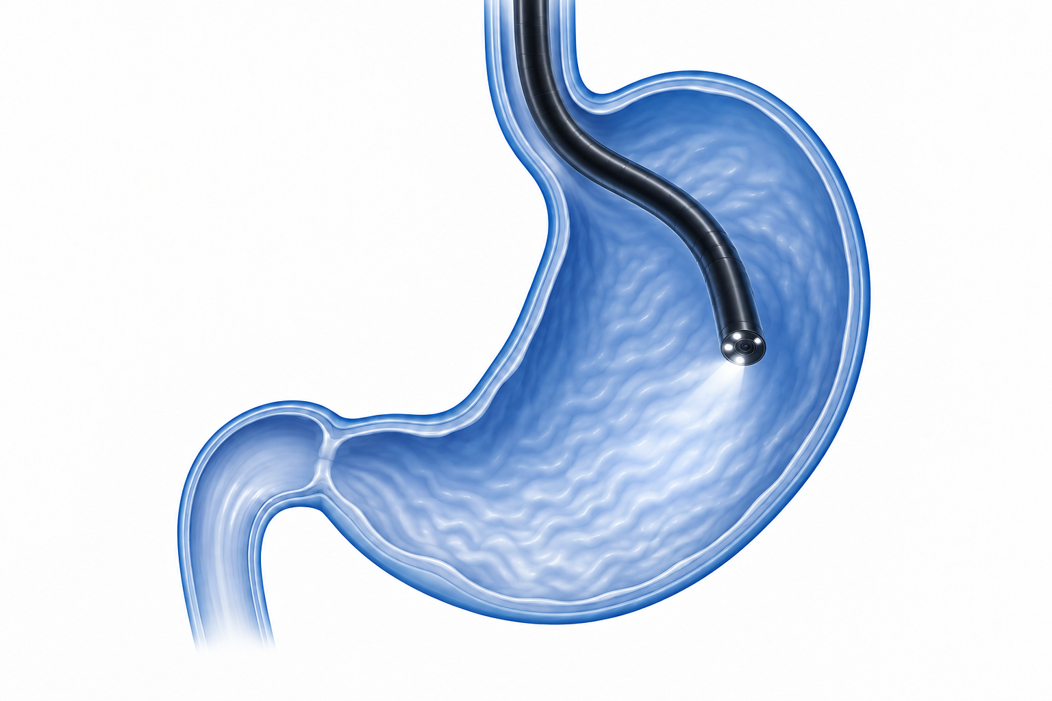 Ilustración conceptual de un endoscopio dentro del estómago